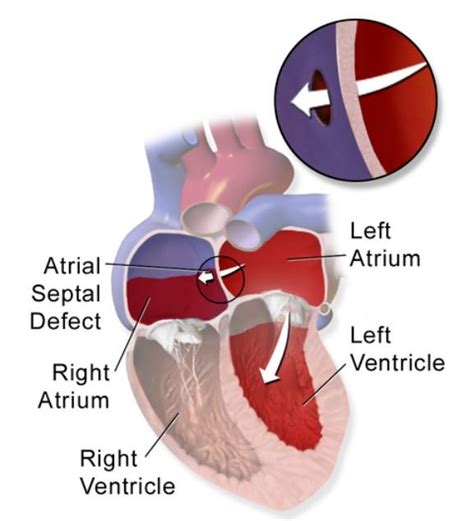 what is a cardiac shunt